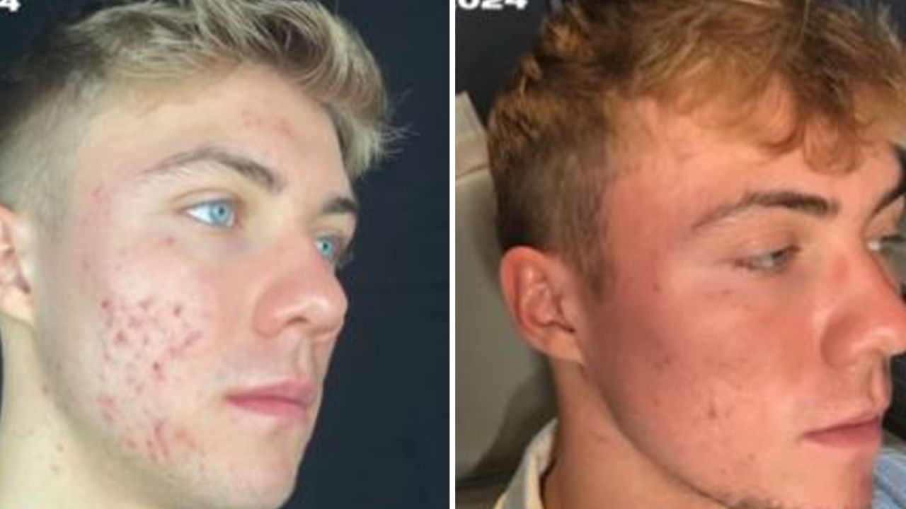 เสริมหล่อหน่อย! ฮอยลุนด์ใช้เวลาพักเดี้ยง รักษาสิว ทำหน้าใส